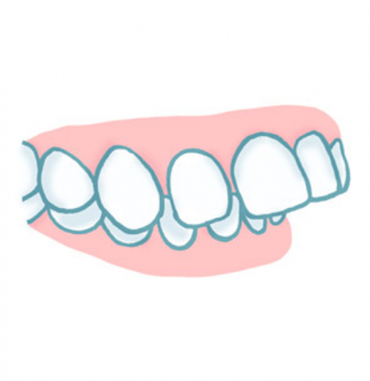 Sobremordida: Qué es, por qué aparece y cómo se corrige