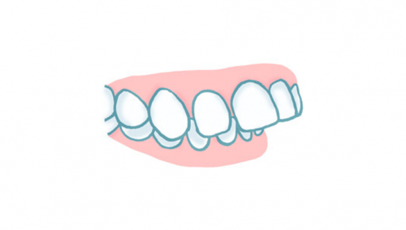 Sobremordida: Qué es, por qué aparece y cómo se corrige
