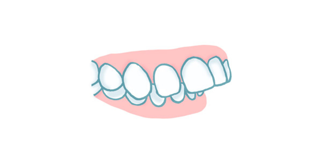 Sobremordida: Qué es, por qué aparece y cómo se corrige