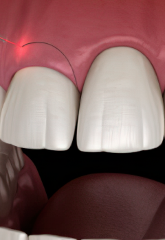 Gingivectomía: Mejora la salud y apariencia de tus encías