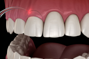 Gingivectomía: Mejora la salud y apariencia de tus encías