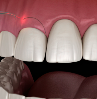 Gingivectomía: Mejora la salud y apariencia de tus encías