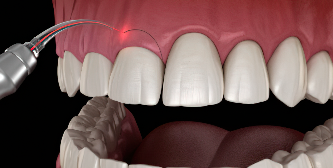 Gingivectomía: Mejora la salud y apariencia de tus encías