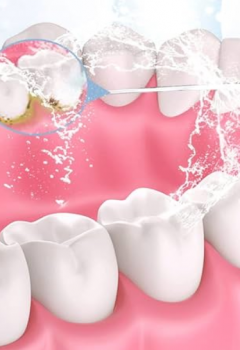 Cómo limpiar implantes dentales y beneficios de un irrigador dental
