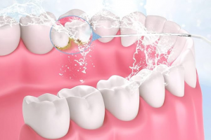 Cómo limpiar implantes dentales y beneficios de un irrigador dental