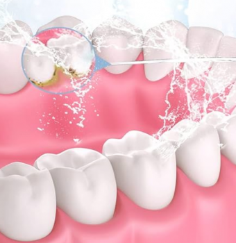 Cómo limpiar implantes dentales y beneficios de un irrigador dental