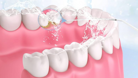 Cómo limpiar implantes dentales y beneficios de un irrigador dental