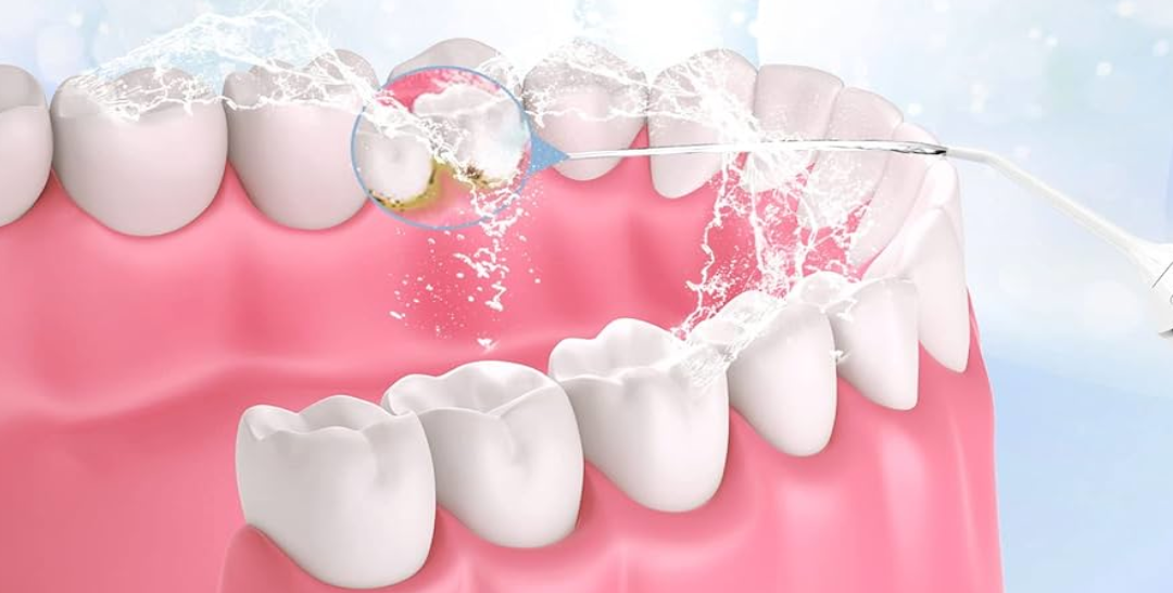 Cómo limpiar implantes dentales y beneficios de un irrigador dental