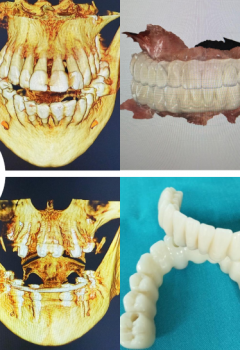 Implantología: Proceso de diagnóstico digital y cirugía de carga inmediata