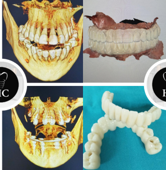 Implantología: Proceso de diagnóstico digital y cirugía de carga inmediata