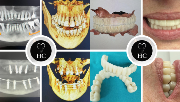 Implantología: Proceso de diagnóstico digital y cirugía de carga inmediata
