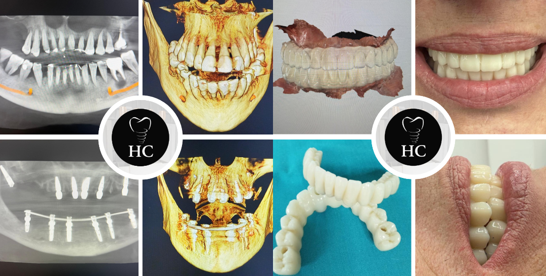Implantología: Proceso de diagnóstico digital y cirugía de carga inmediata