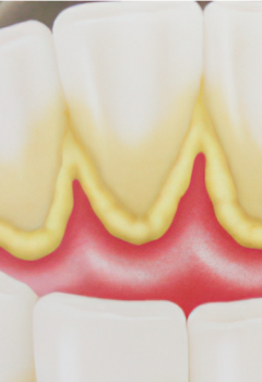 Qué es la Placa Dental y Cómo Eliminarla