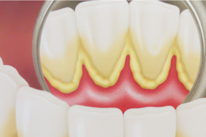 Qué es la Placa Dental y Cómo Eliminarla