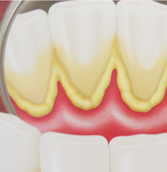 Qué es la Placa Dental y Cómo Eliminarla