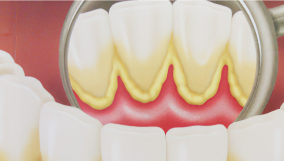 Qué es la Placa Dental y Cómo Eliminarla