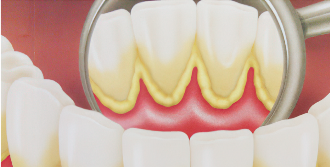 Qué es la Placa Dental y Cómo Eliminarla