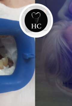 Estética Dental: ¿Cuál es el Color Natural de los Dientes?