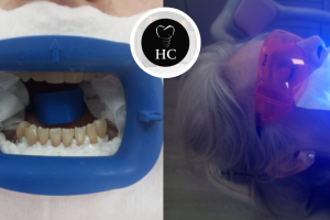 Estética Dental: ¿Cuál es el Color Natural de los Dientes?