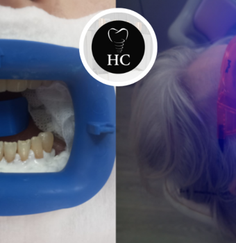 Estética Dental: ¿Cuál es el Color Natural de los Dientes?