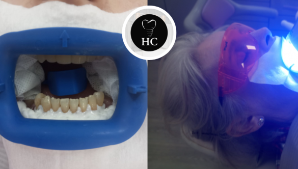 Estética Dental: ¿Cuál es el Color Natural de los Dientes?